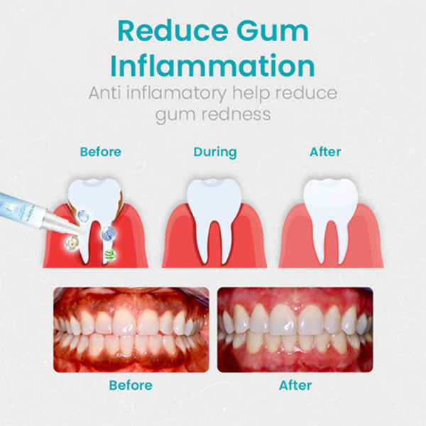 (🎉Last Day Sale-80% Off🔥))NESLEMY™ Gum Shield Therapy Gel