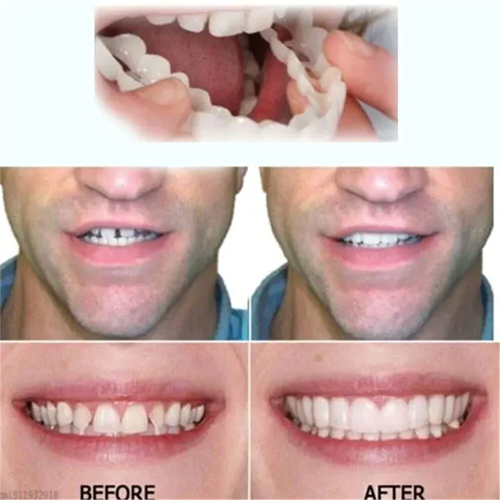 (Limited Time Discount 🔥 Last Day)DIYSTAR™Adjustable Snap-On Dentures⭐