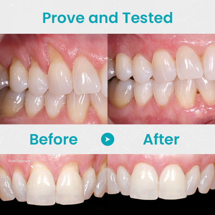 (🎉Last Day Sale-80% Off🔥))NESLEMY™ Gum Shield Therapy Gel