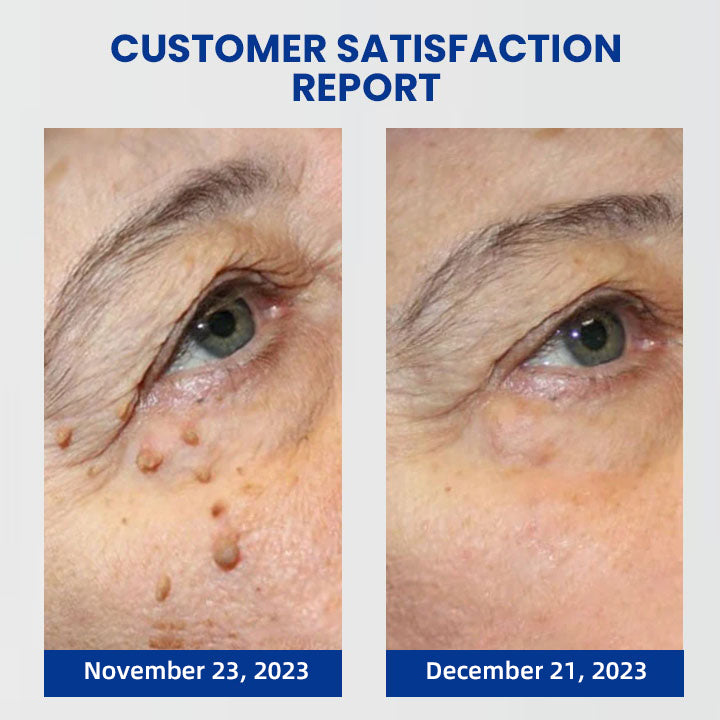 (🔥Last Day Sale-80% Off🔥)Lovilds™ Instant Blemish Removal Cream