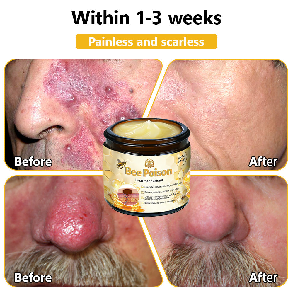 LOVILDS™ Bee Poison Skin Treatment Cream (AAD Recommended)🍓🍓