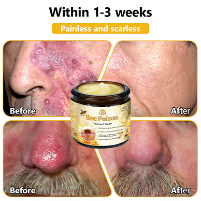 LOVILDS™ Bee Poison Skin Treatment Cream (AAD Recommended)🍓🍓