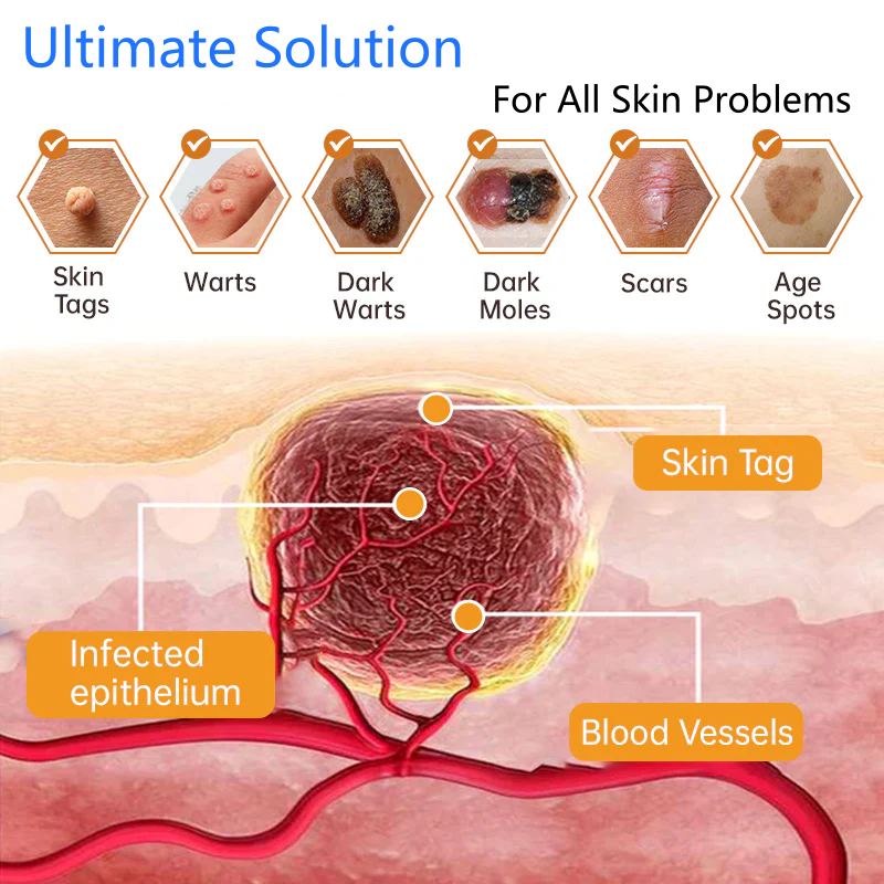 Lovilds® Non-Invasive Mole and Wart Removal Laser Pen