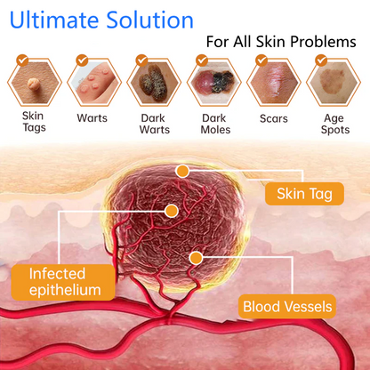 Lovilds® Non-Invasive Mole and Wart Removal Laser Pen
