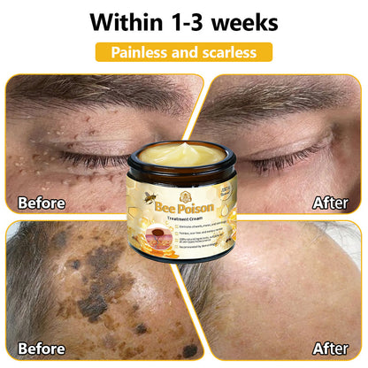 LOVILDS™ Bee Poison Skin Treatment Cream (AAD Recommended)🍓🍓