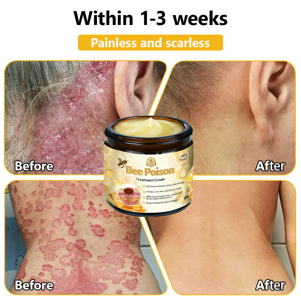 LOVILDS™ Bee Poison Skin Treatment Cream (AAD Recommended)🍓🍓