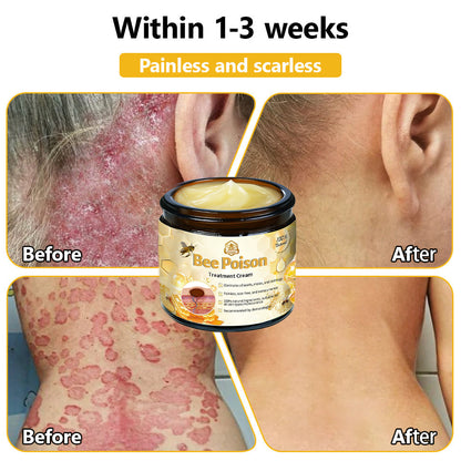 LOVILDS™ Bee Poison Skin Treatment Cream (AAD Recommended)🍓🍓