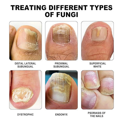 NEWYUO™ Anti-Fungal Pen – Gets Rid Of Even the Most Stubborn Nail Fungus