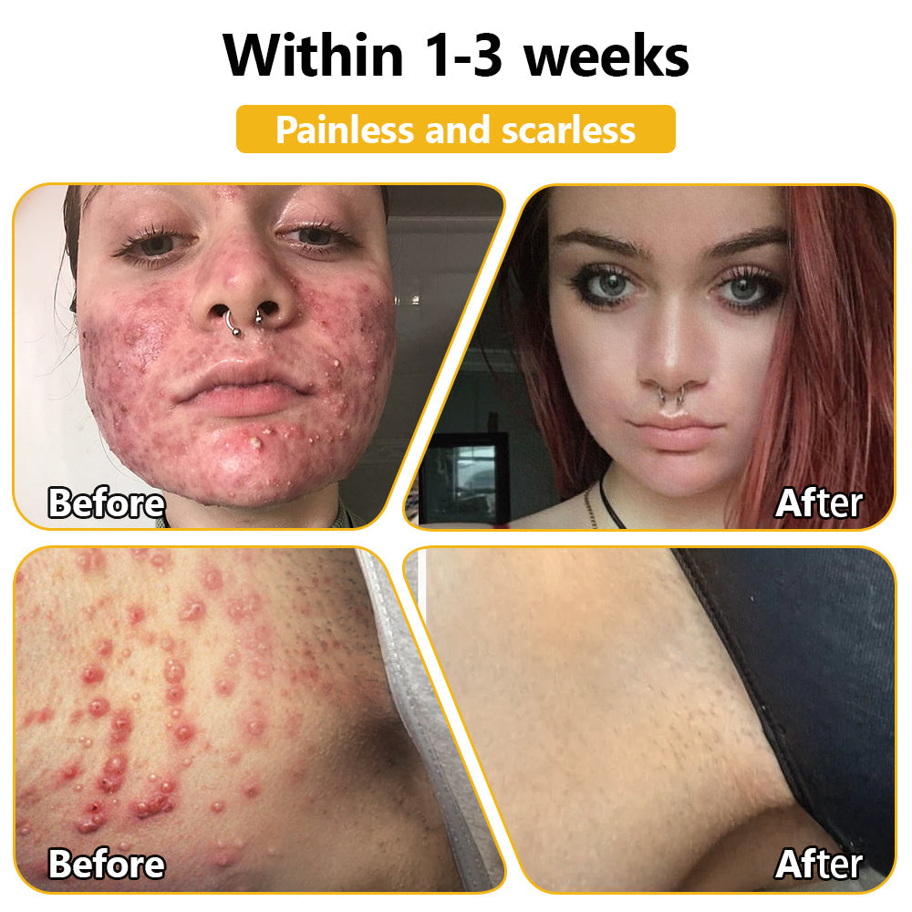 LOVILDS™ Bee Poison Skin Treatment Cream (AAD Recommended)🍓🍓