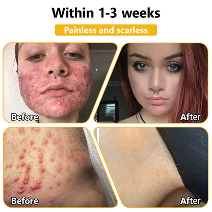 LOVILDS™ Bee Poison Skin Treatment Cream (AAD Recommended)🍓🍓